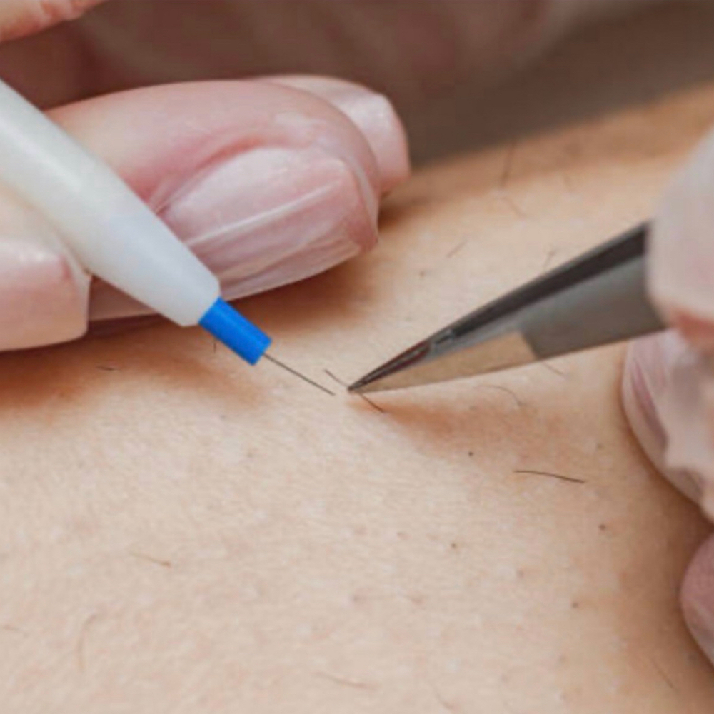 Electrolysis Treatment | 45 Minutes at Elite Electrology in Medford, WI