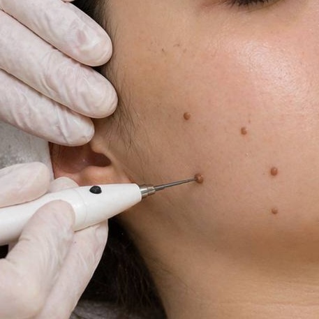 Electrocoagulation with Plasma Pen at La VILNA in Jacksonville, FL
