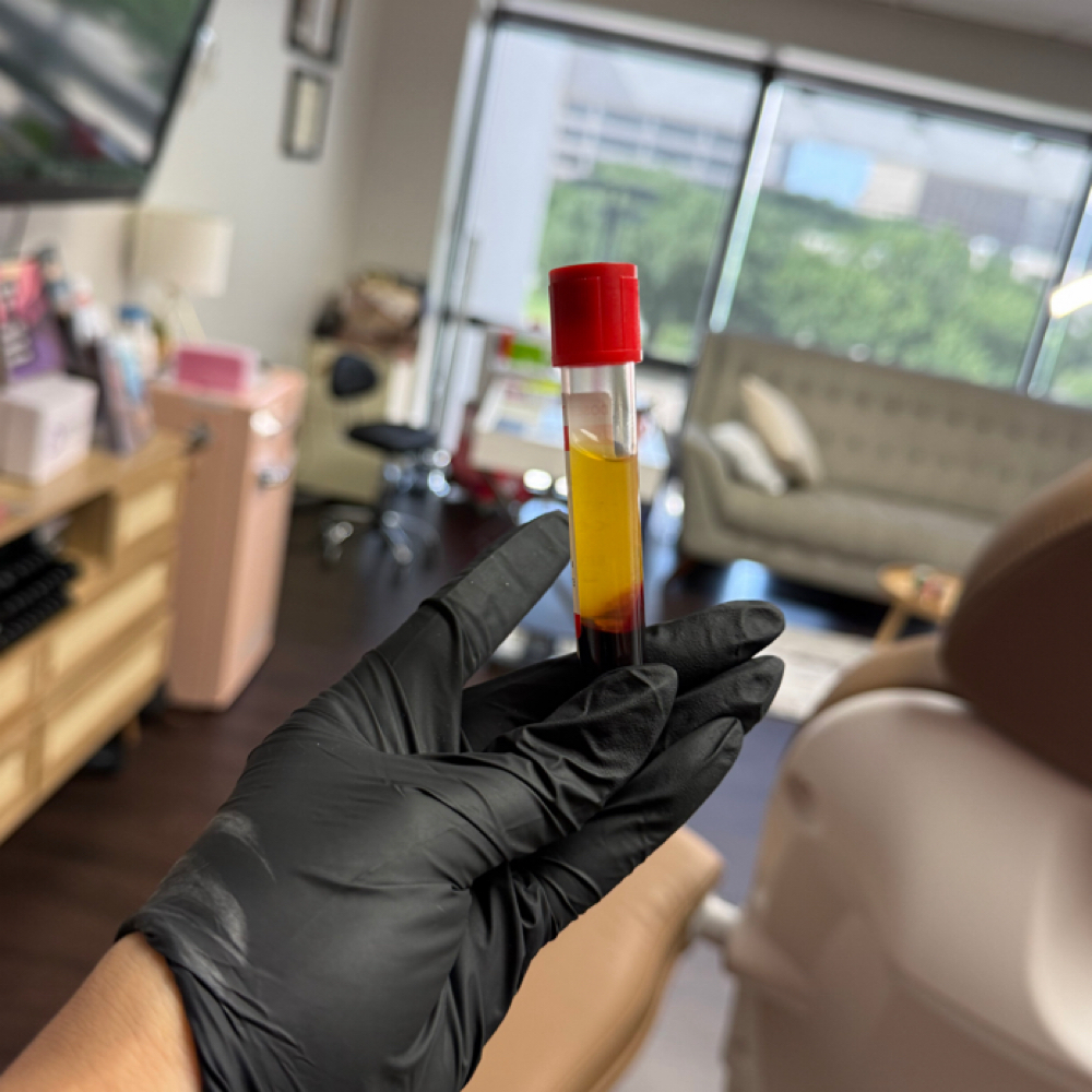 EZ Gel/PRF ( Full Face) at 1111 Aesthetics & Wellness LLC in Irving, TX