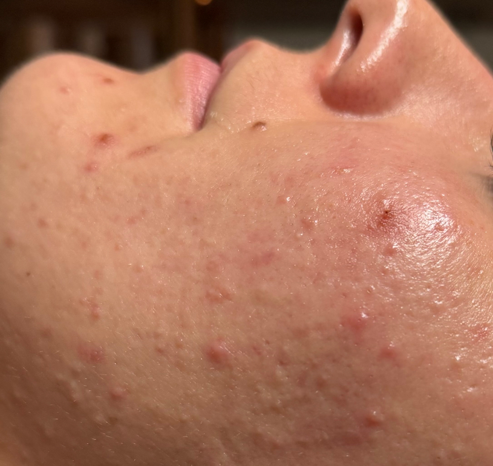 Mini Facial at MadSkin Esthetics in Colorado Springs, CO