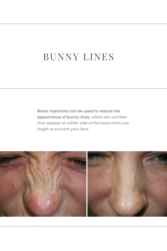 Bunny Lines