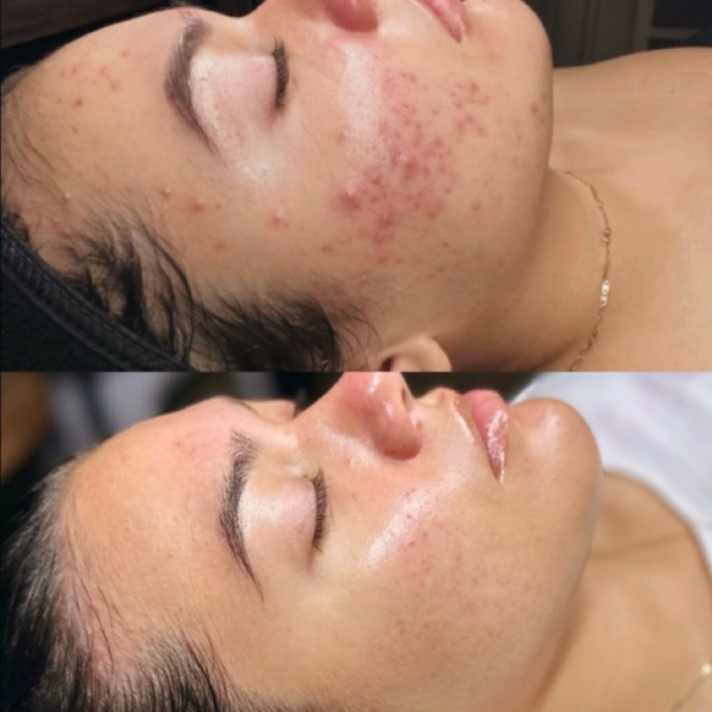Teen Facial at That Rose Glow in Merced, CA
