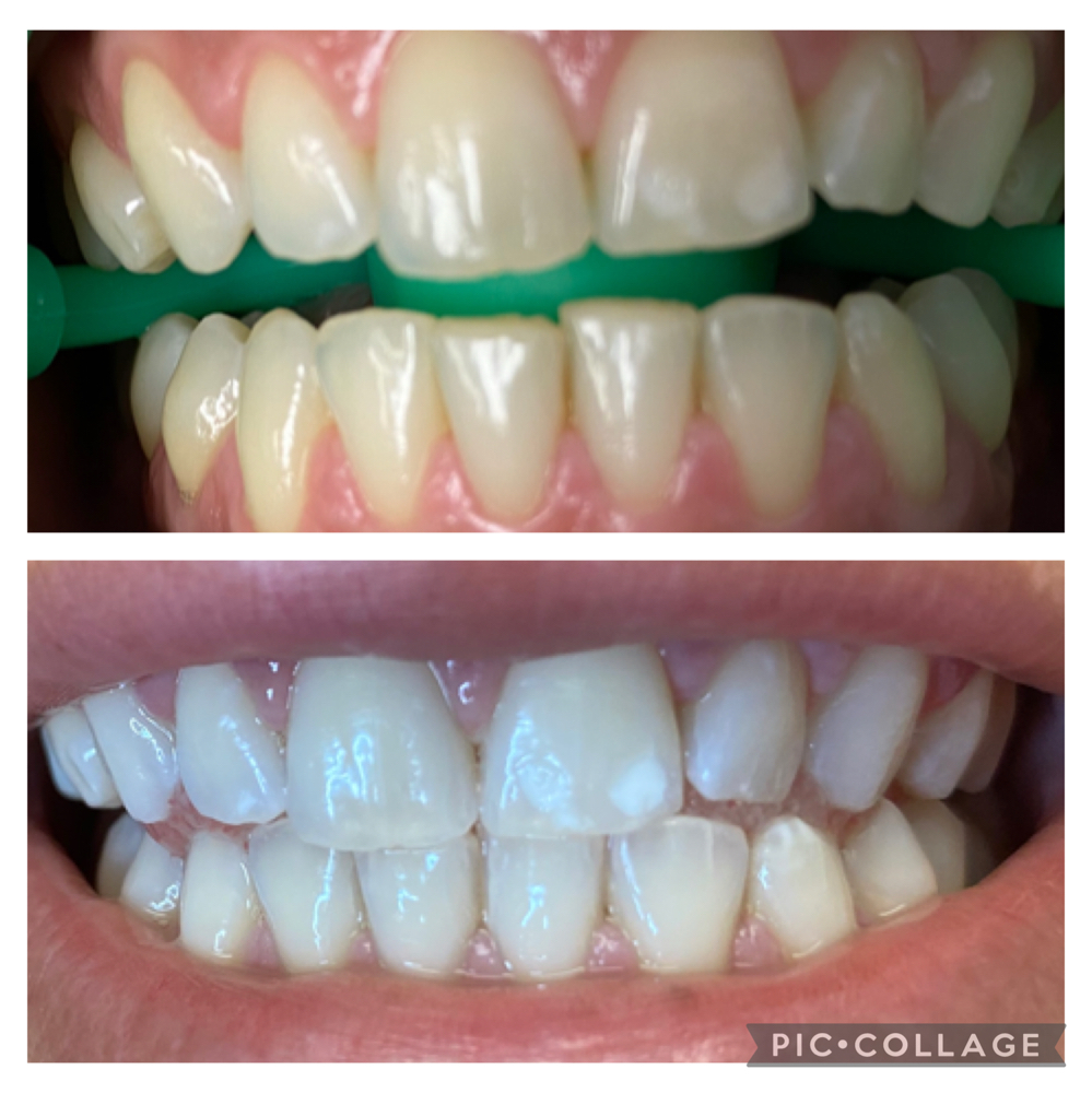 60 Min Teeth whitening