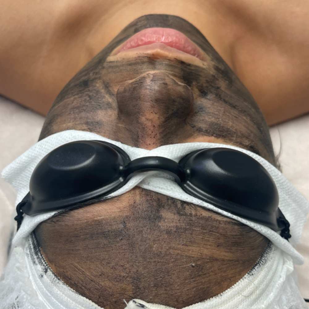 Carbon Glow Laser Facial