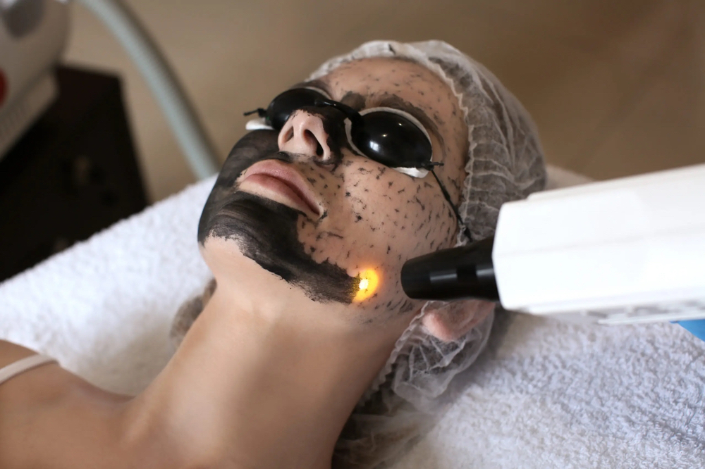 Carbon Peel