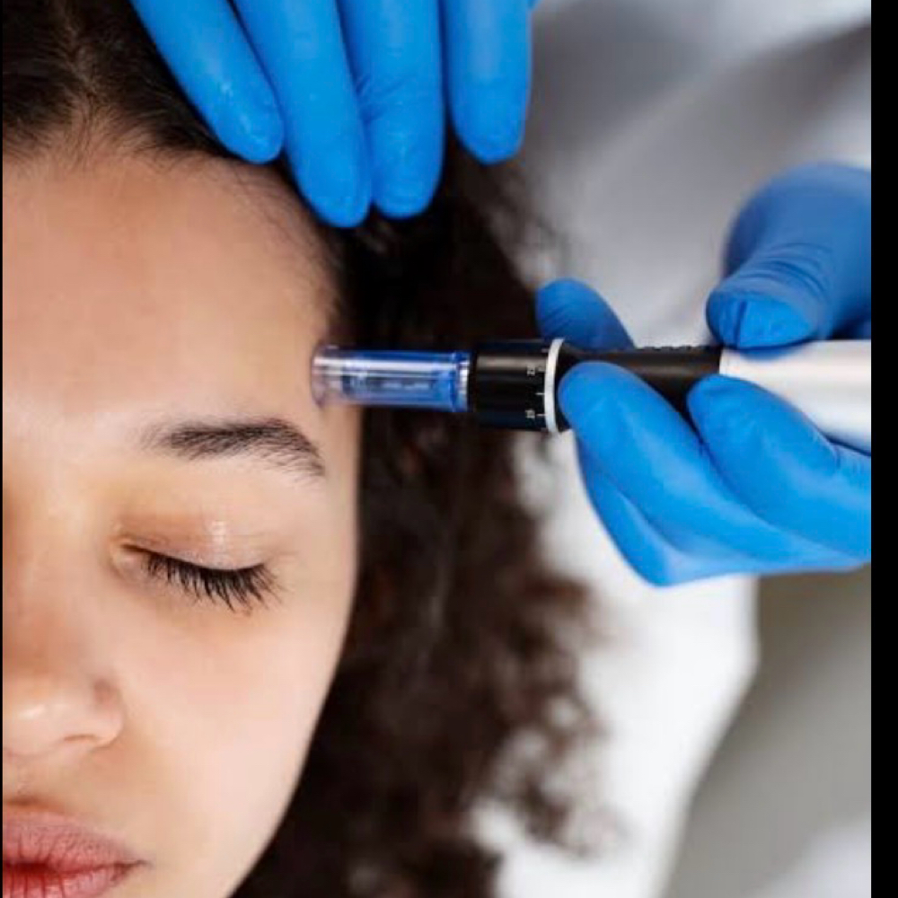 The Activation Vibe — Microneedling at Vibe Skin Lab in Woburn, MA
