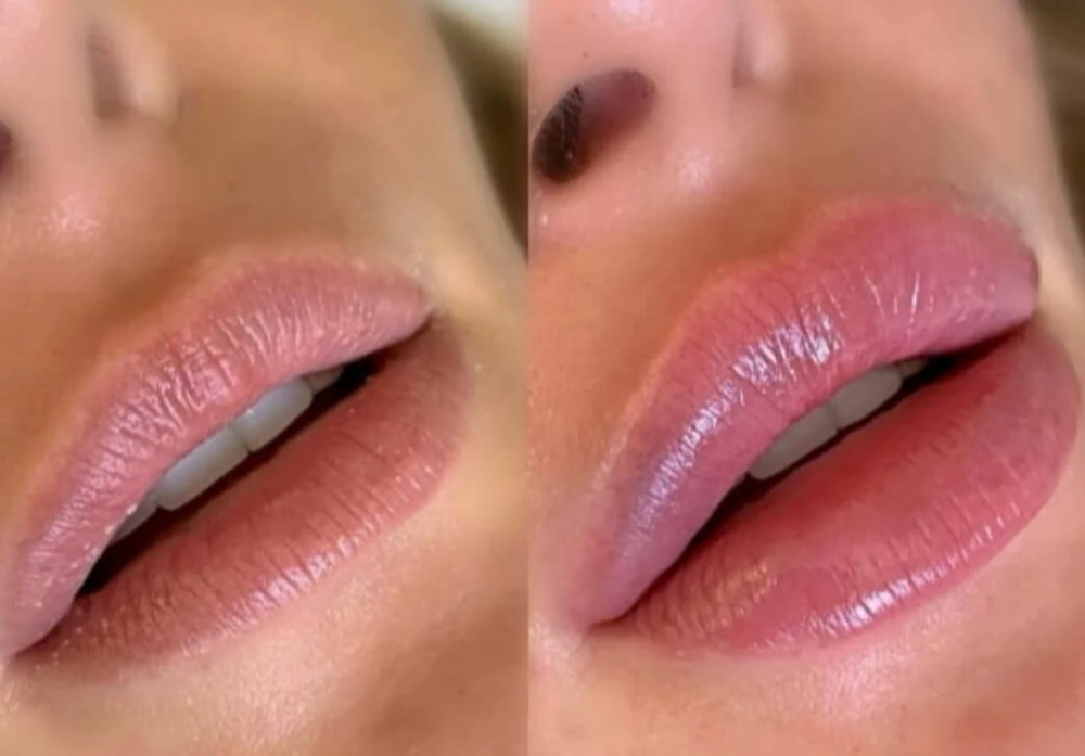 Hydra Lips