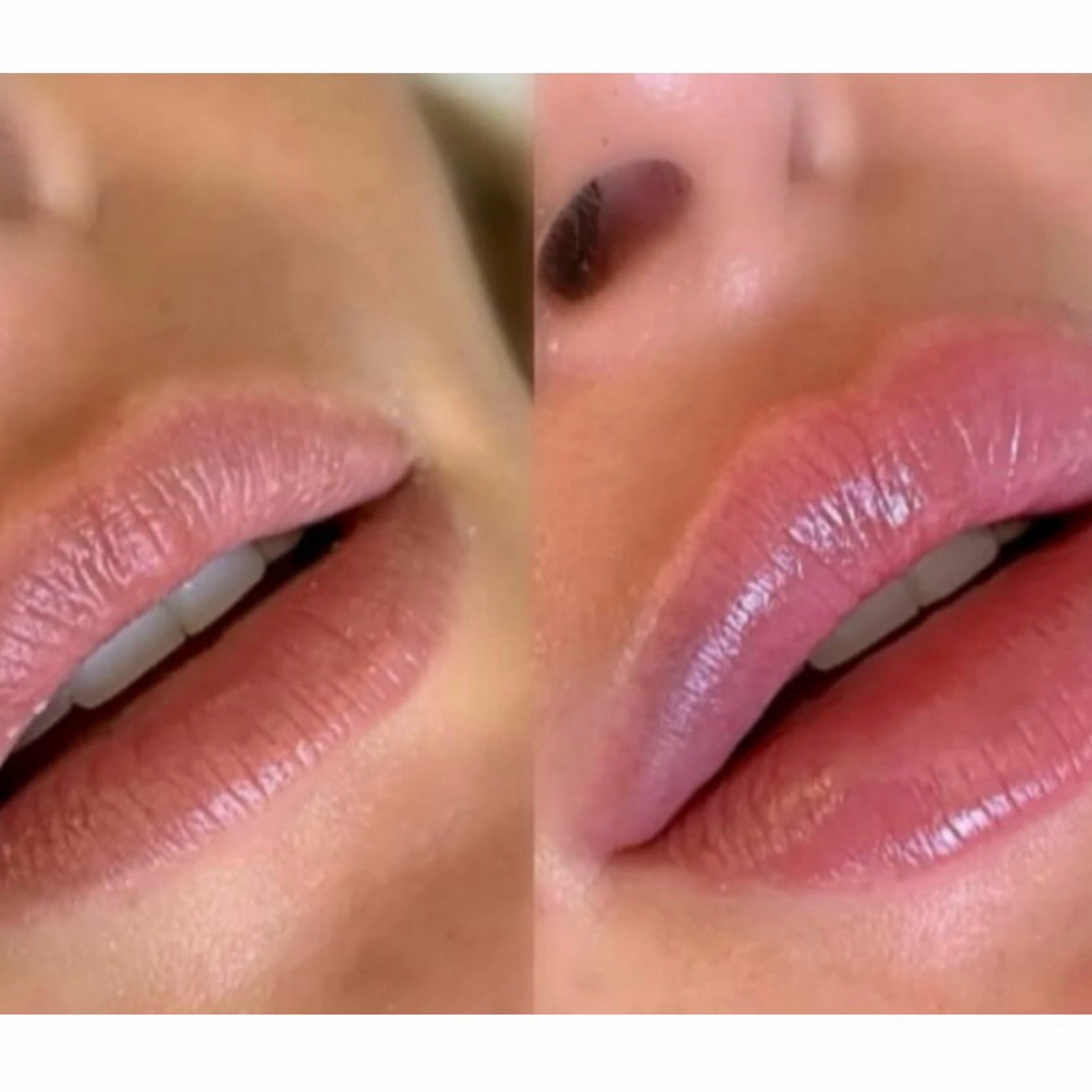 Lip Rejuvenation at V Glow Miami in Miami Beach, FL