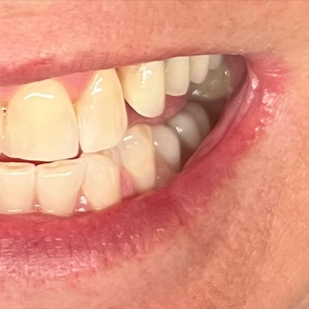 Teeth Whitening 60 minutes at Beauty By Stevie D in Livingston, TX
