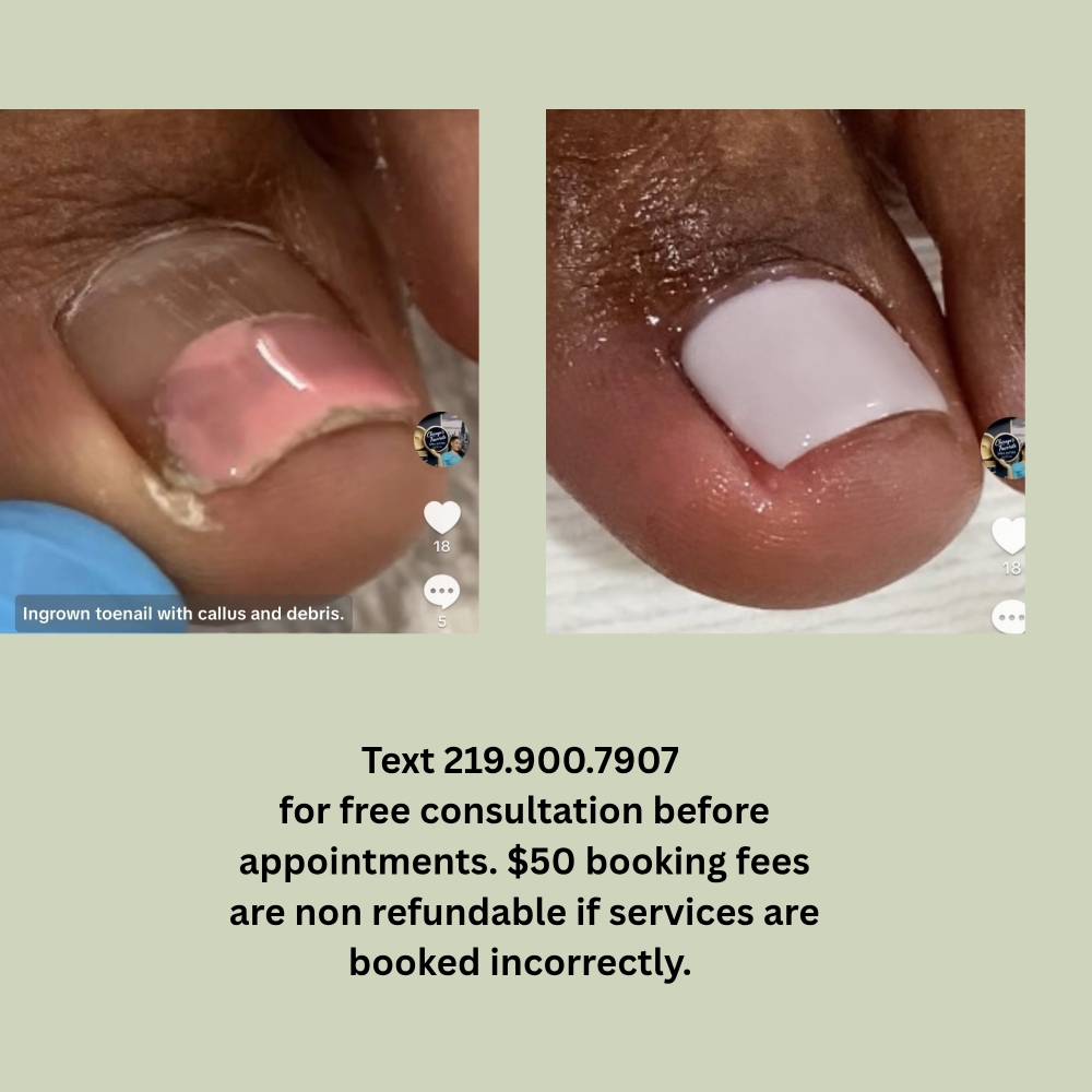 Ingrown Toenails (Stage 1) at Chicago's Favorite Nail Spa in Lansing, IL