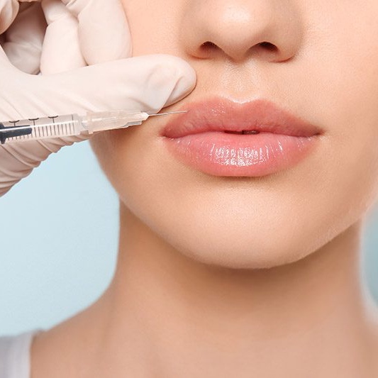 Full Syringe Lip Filler at Athena Med Spa in San Antonio, TX