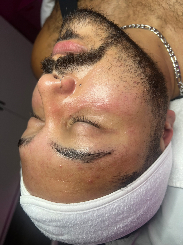 Hydrodermabrasion Facial