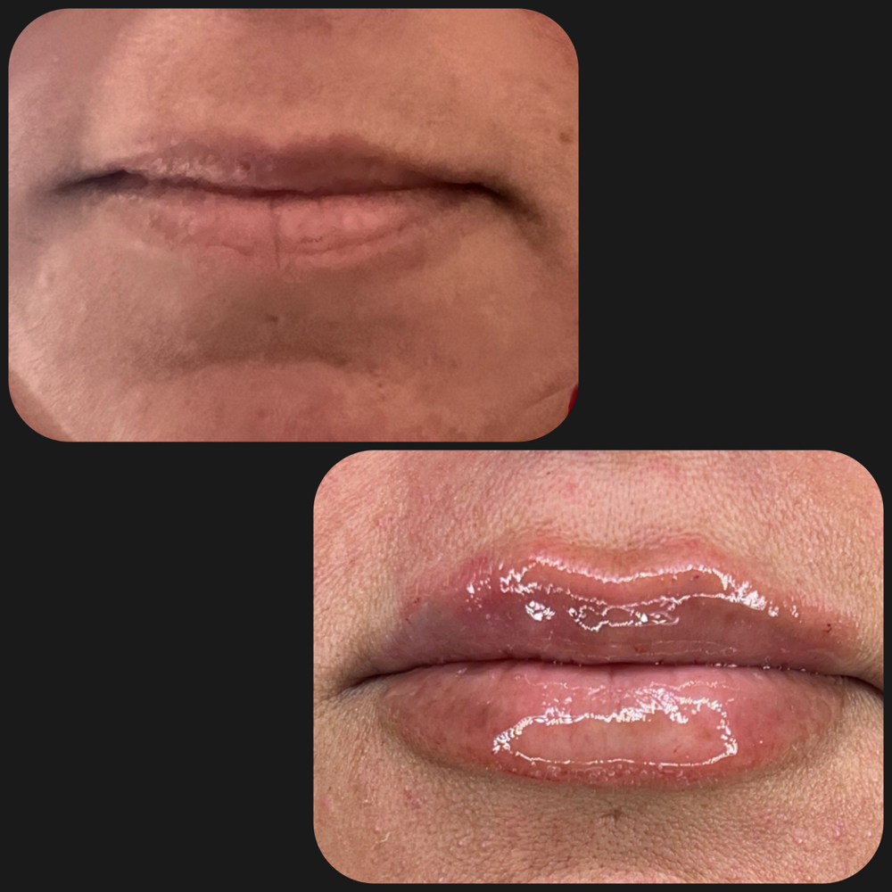 Lip Filler