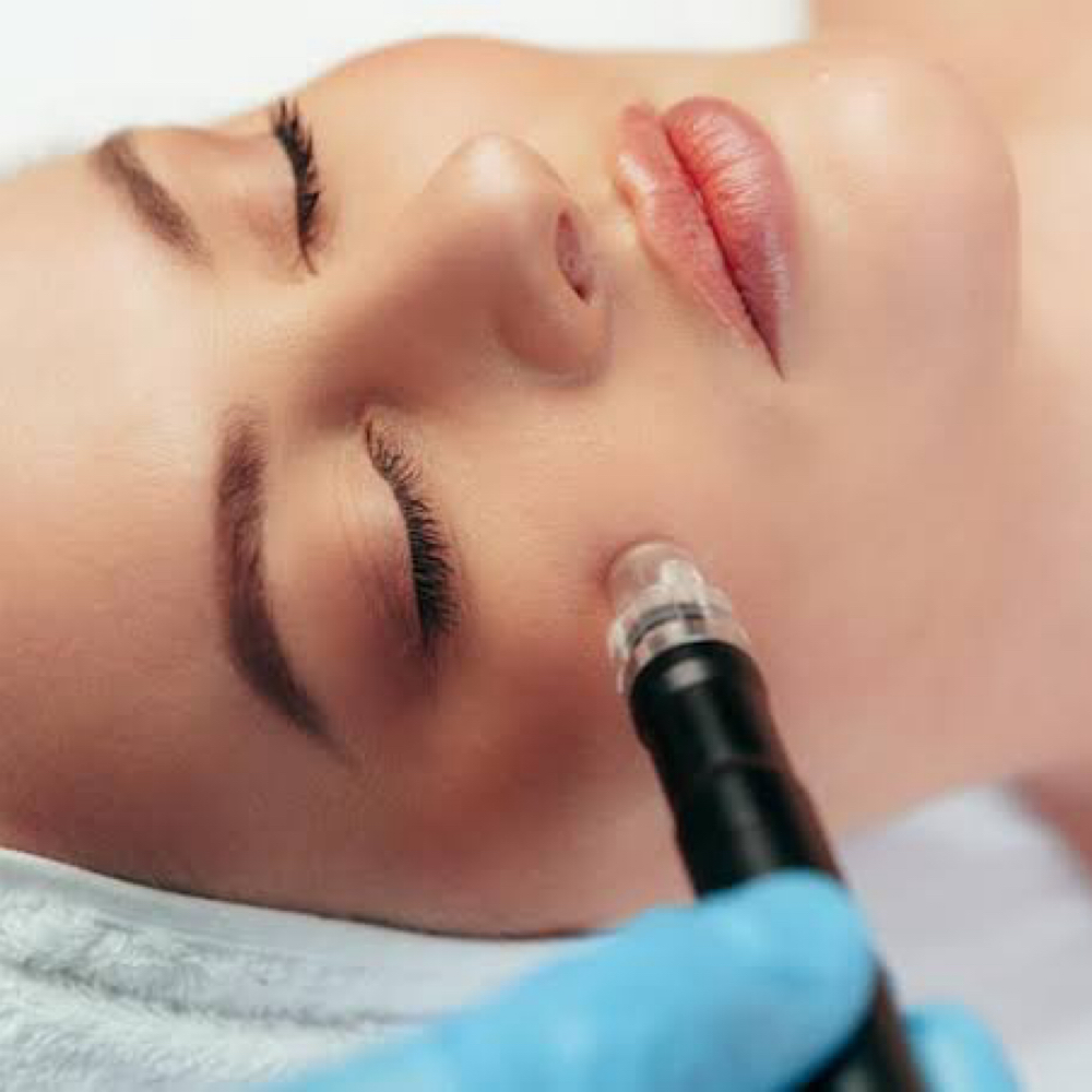 Microneedling at Golden State Glam in Fair Oaks, CA