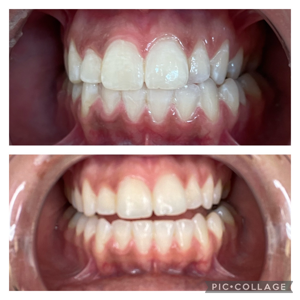 Teeth Whitening 40 Minutes