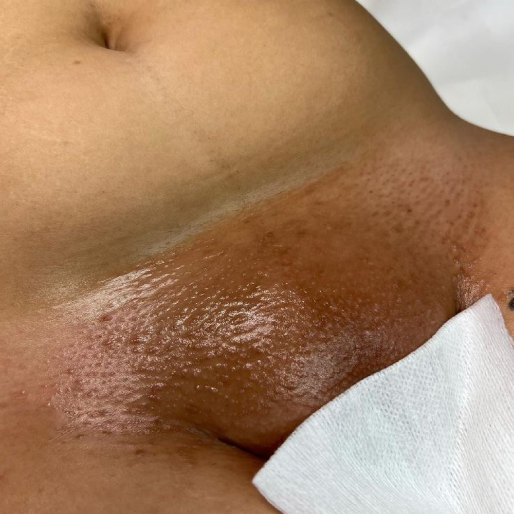 Bikini Full (First Time Client) at GlowedByMari in Houston, TX