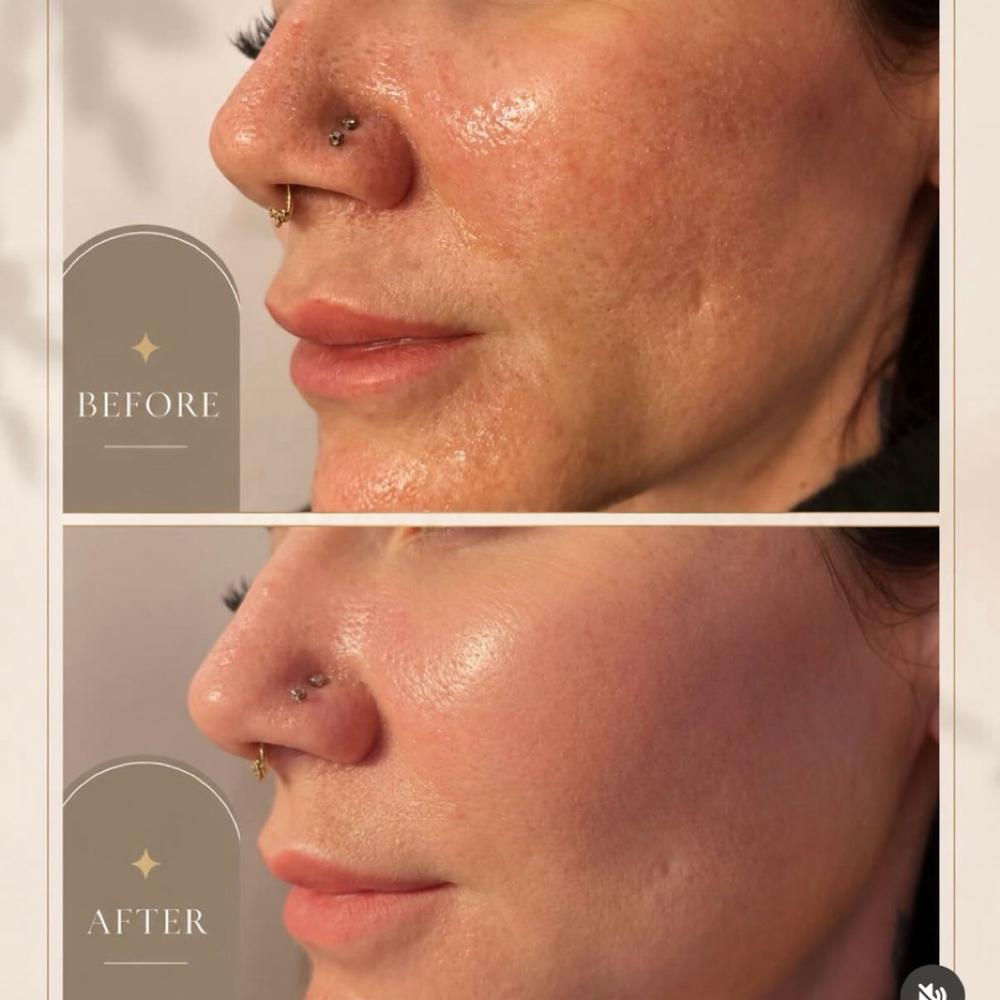 Microneedling Face&Neck at ArteSana by Steph in Altamont, NY