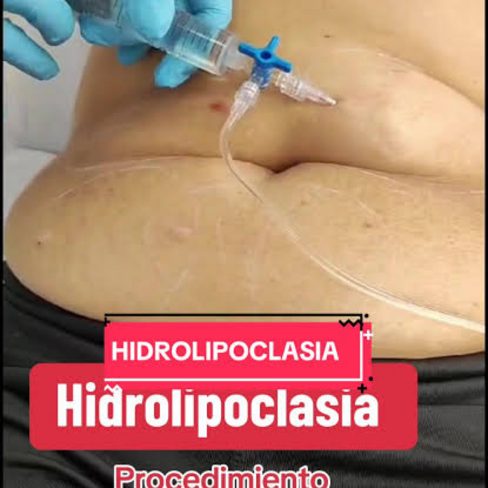 Hidrolipoclasia at RossyEstetic in Metaire, LA