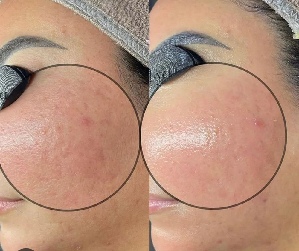 HydroDiamond Glow Facial