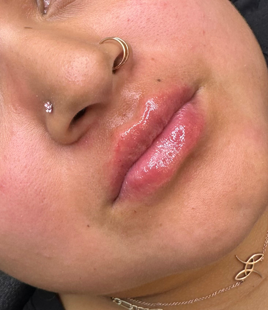 1Ml needle-less (1 Syringe)