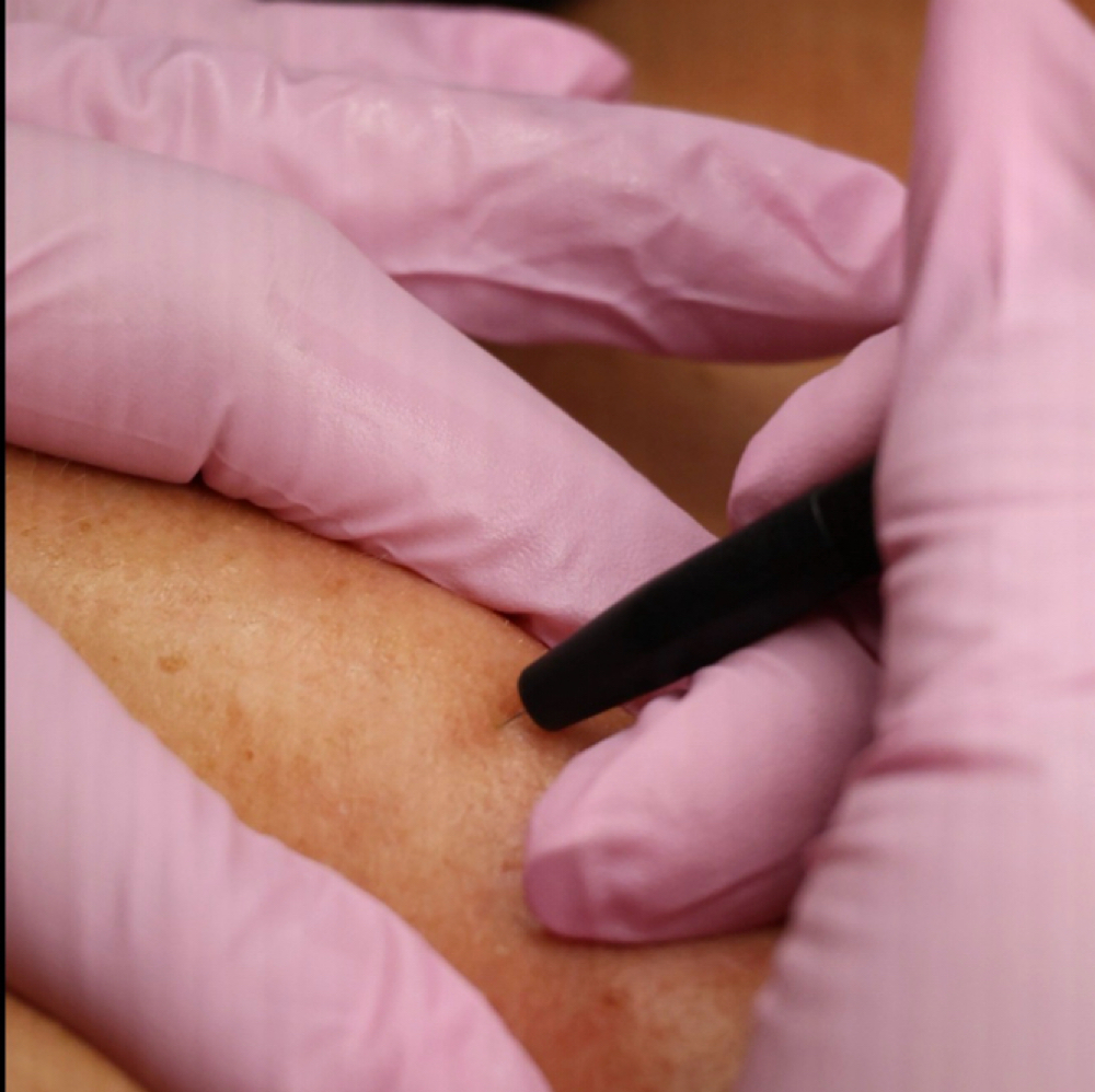 Electrolysis-60 minutes at Skin Studio 57 in Woburn, MA