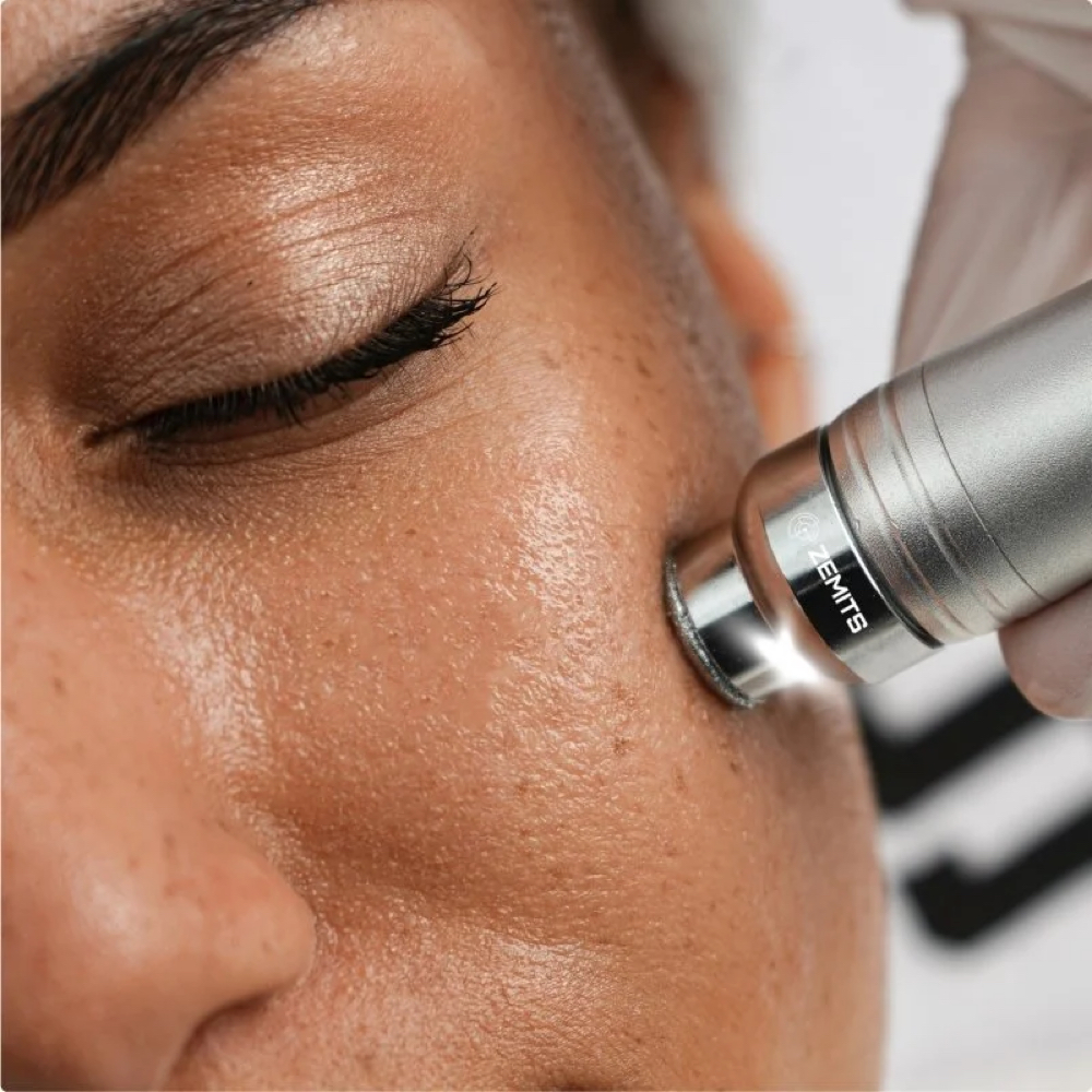 Signature HydroDiamond Custom Facia at New Leaf Esthetics in Fresno, CA