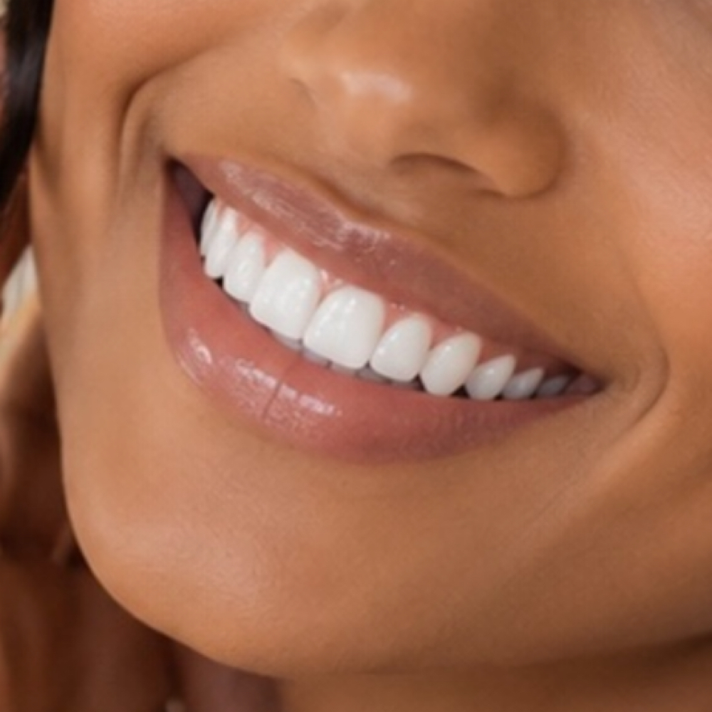 60-Minute Whitening at Afterglo Organic Teeth Whitening East in Milwaukee, WI