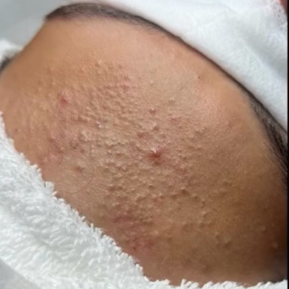 DEEP PORE FACIAL at Kai_Esthetics in Brookfield, CT