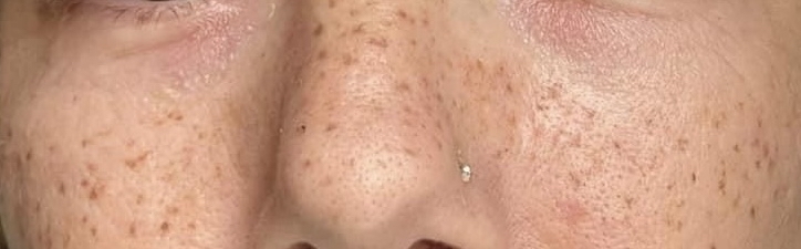 Freckles