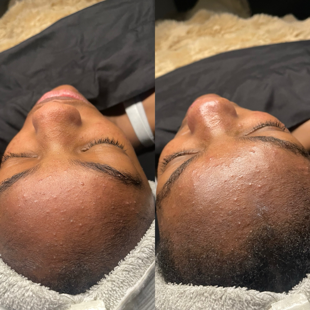 Hydro-Infusion at Lanai Beauty Bar in Concord, CA