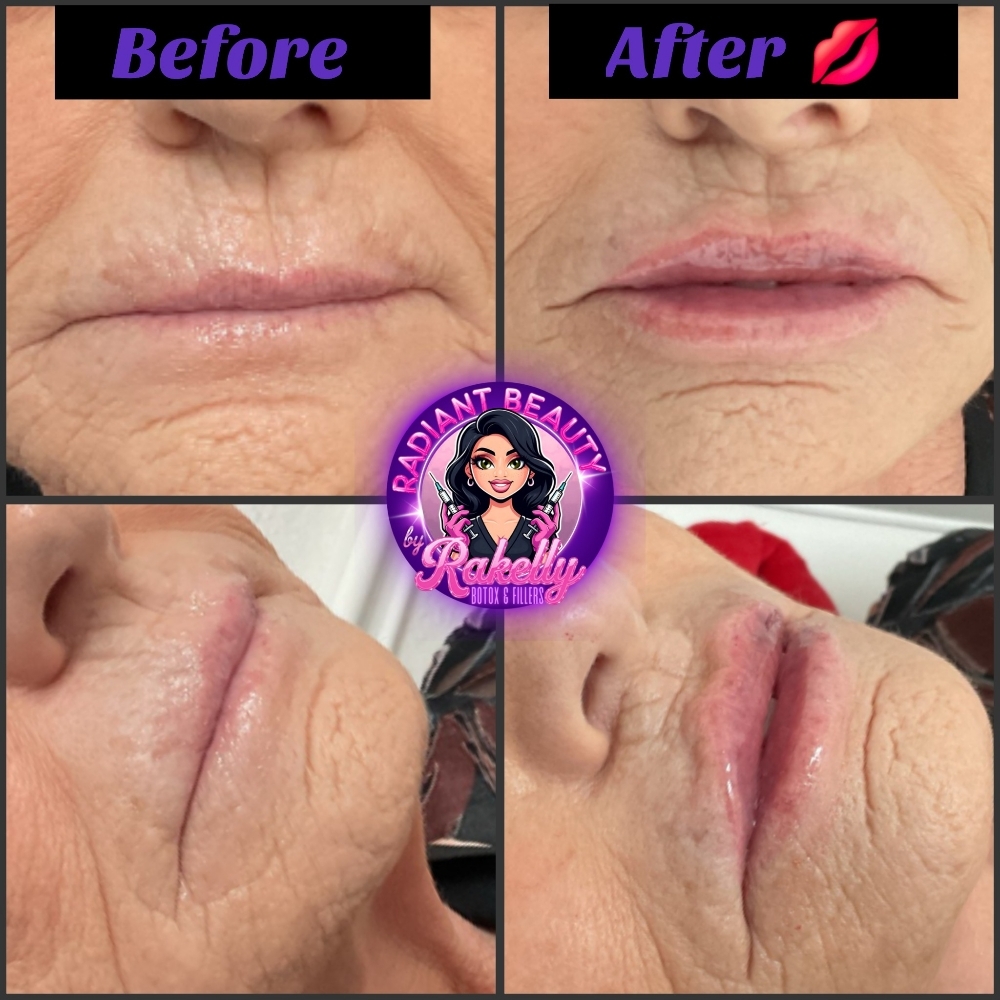 1 Ml Juvederm at Radiant Beauty By Rakelly LLC in Fort Worth, TX