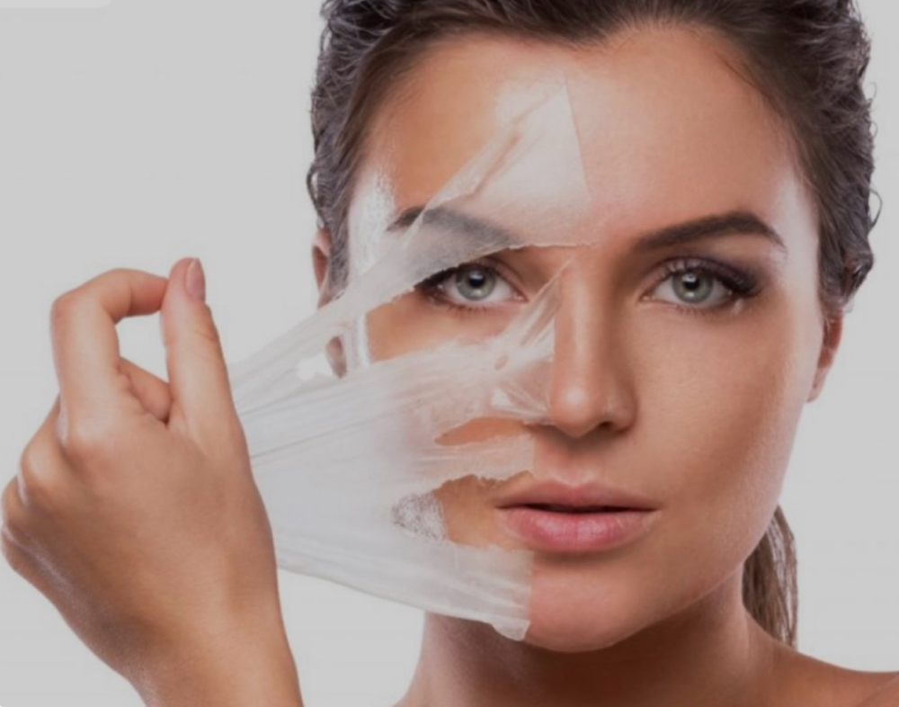 VI Peel Advance