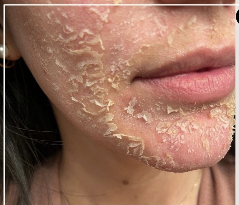 🌿 Perfect Derma Peel (Mid Level)