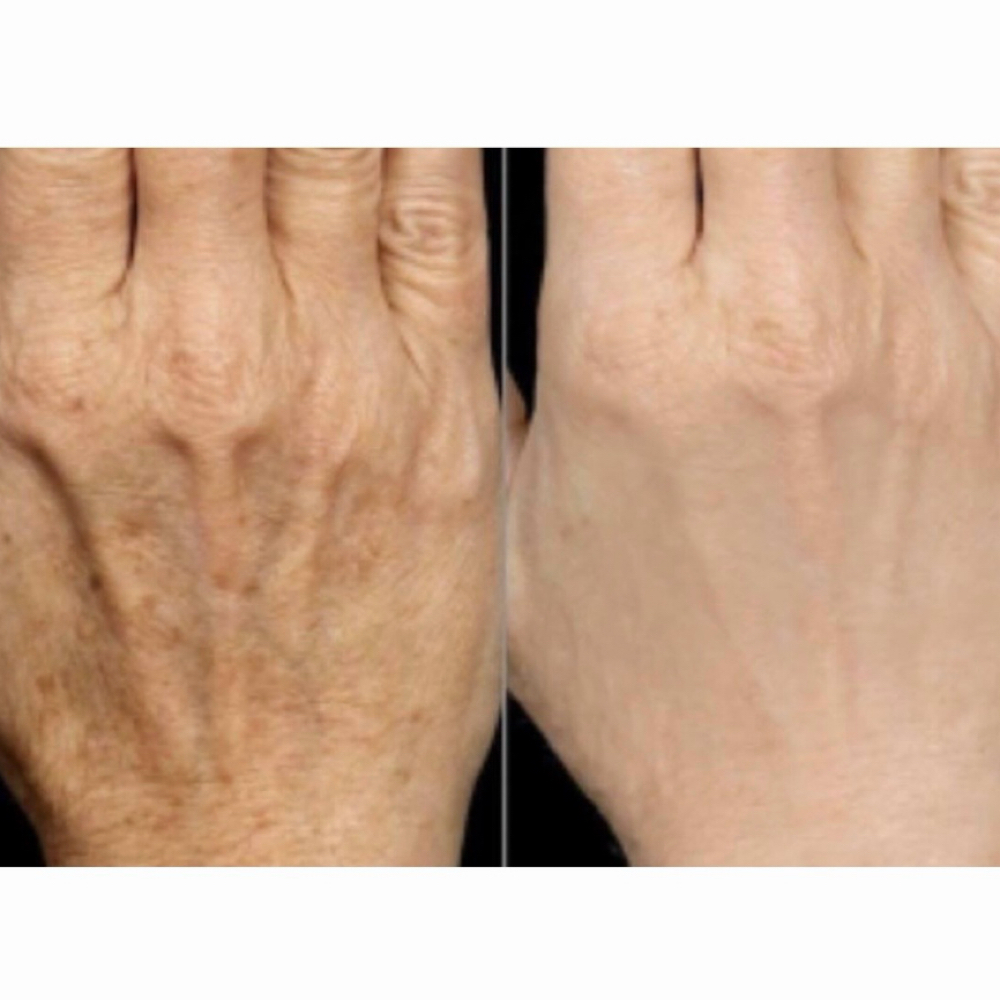 Procell Microchanneling Hands at Skin Deep Esthetics in Columbus, MS
