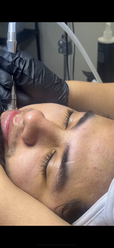 Microdermabrasion Facial