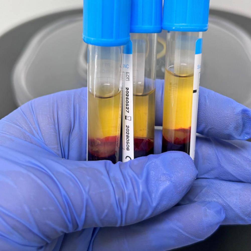 Plasma Rico En Plaquetas (PRP)