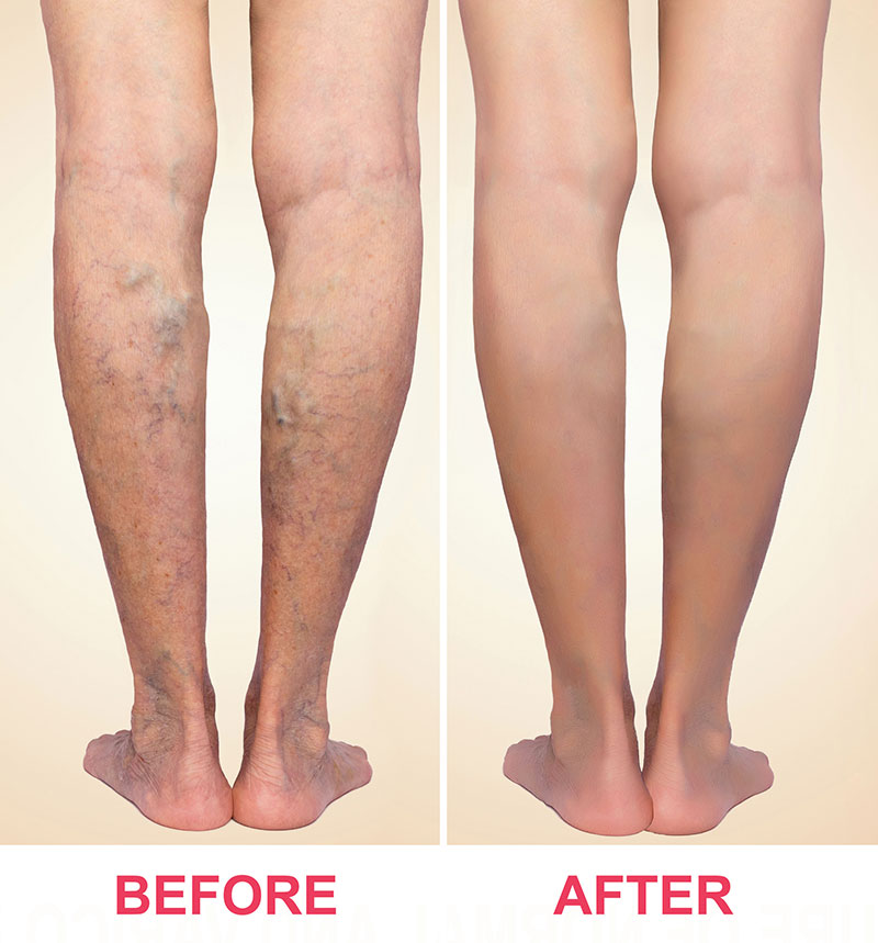 Vein Laser Treatment