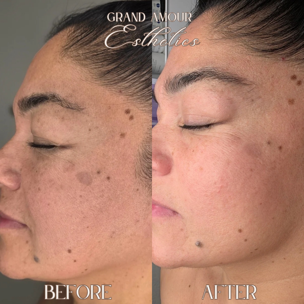 Custom Chemical Peel at Grand Amour Esthetics in Las Vegas, NV