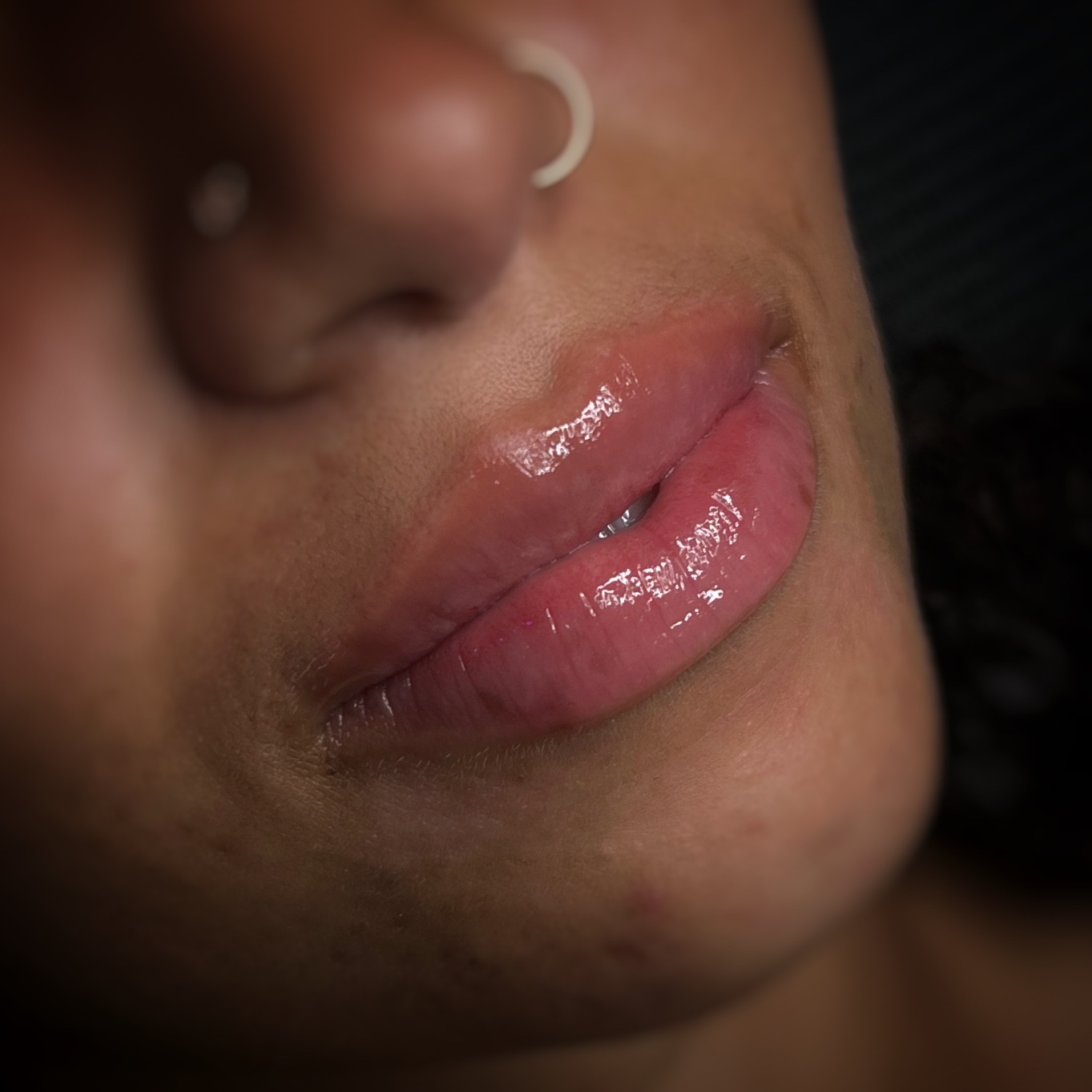 Hyapen Lip Filler at Beauty by Cecily in Sparks, NV