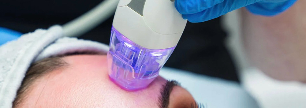 RF Microneedling