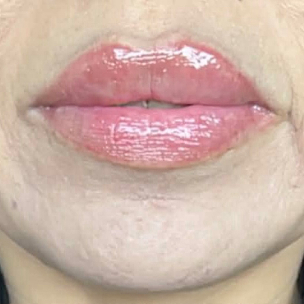 Russian Cupid’s Bow Lift .4ML at Glam X Sam MedBeauty in Andrews, TX