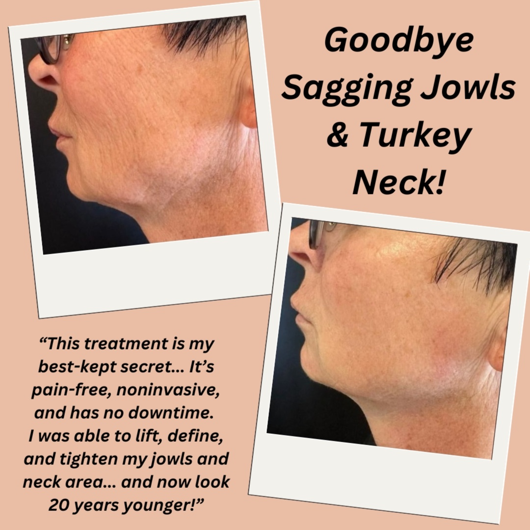 PROMO Double Chin & Neck Treatment at Josephs Rejuvenation Center in Snellville, GA