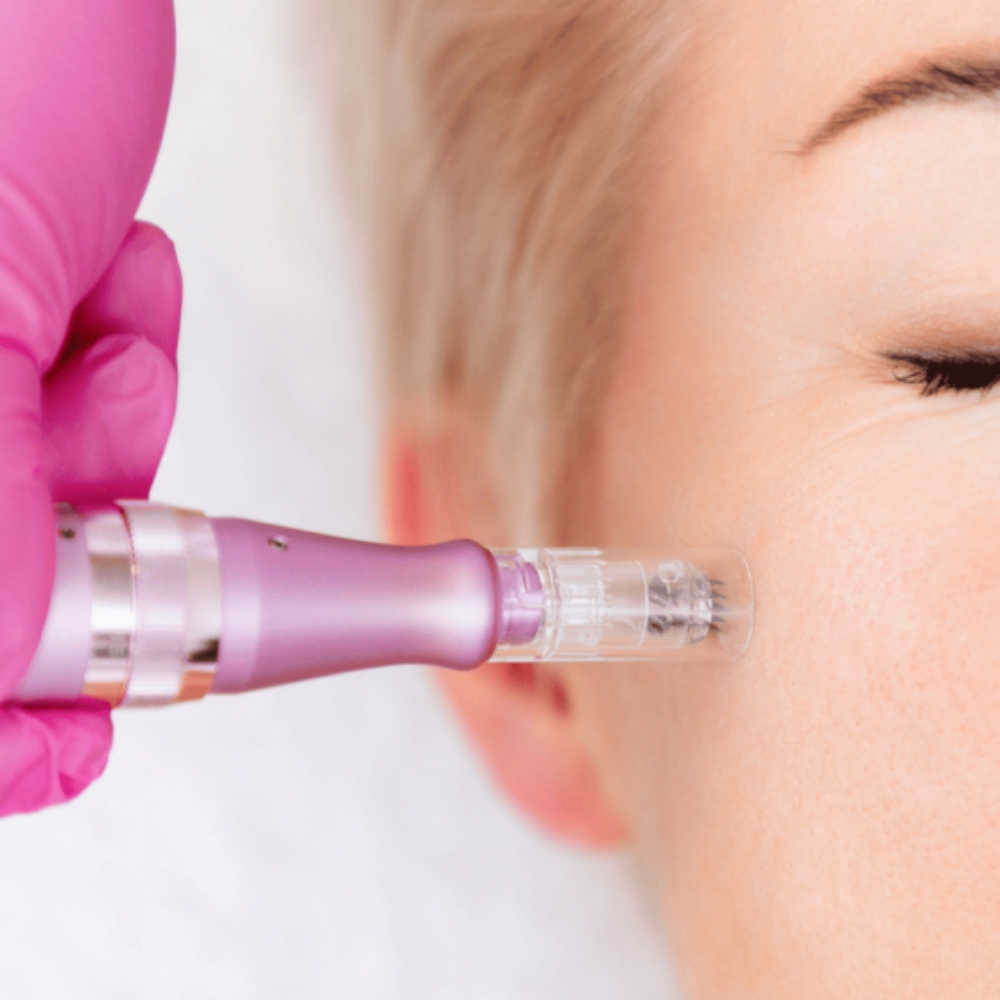 Microneedling at Aeri Aesthetics in Conroe, TX