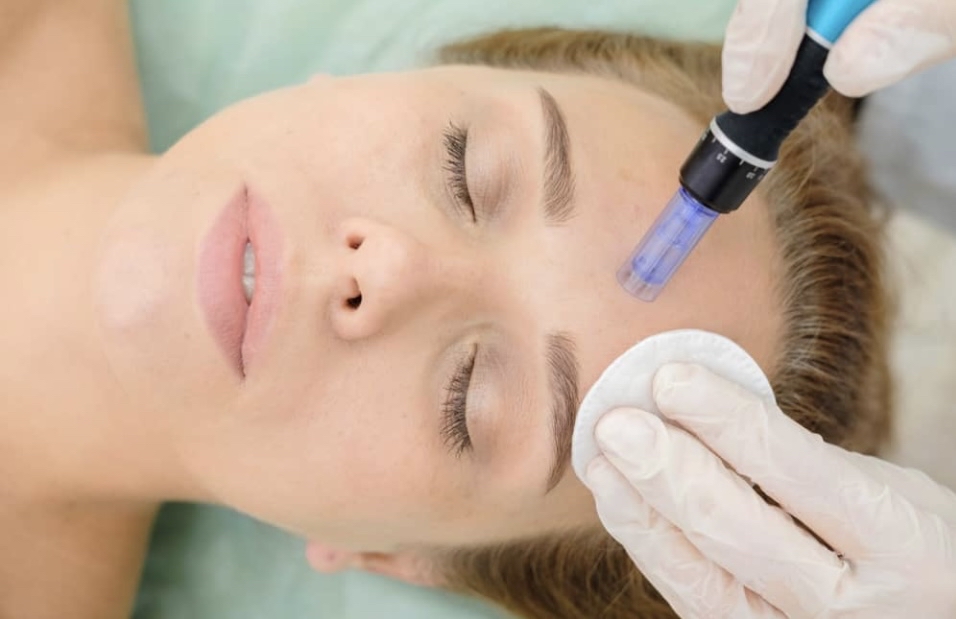 Microneedling