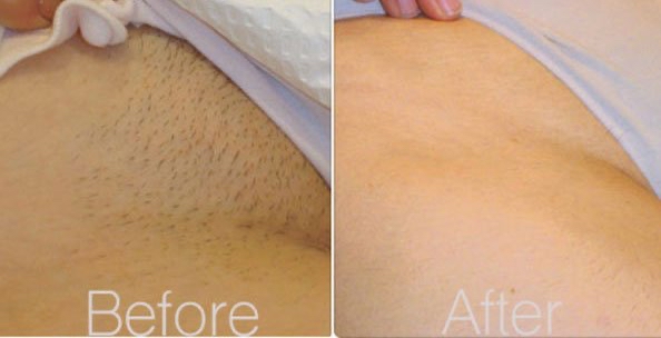 bikini wax