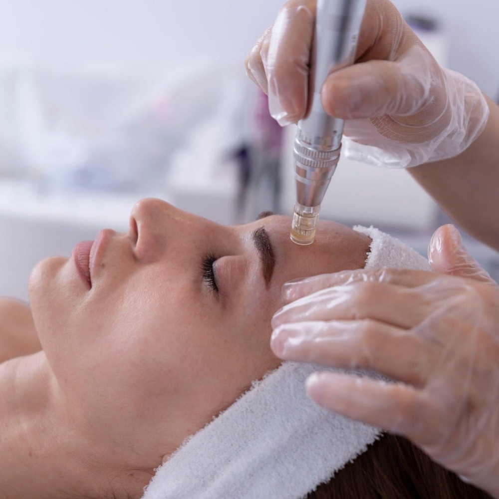 Microneedling With Facial