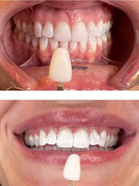 Red Carpet Luxe Teeth Whitening