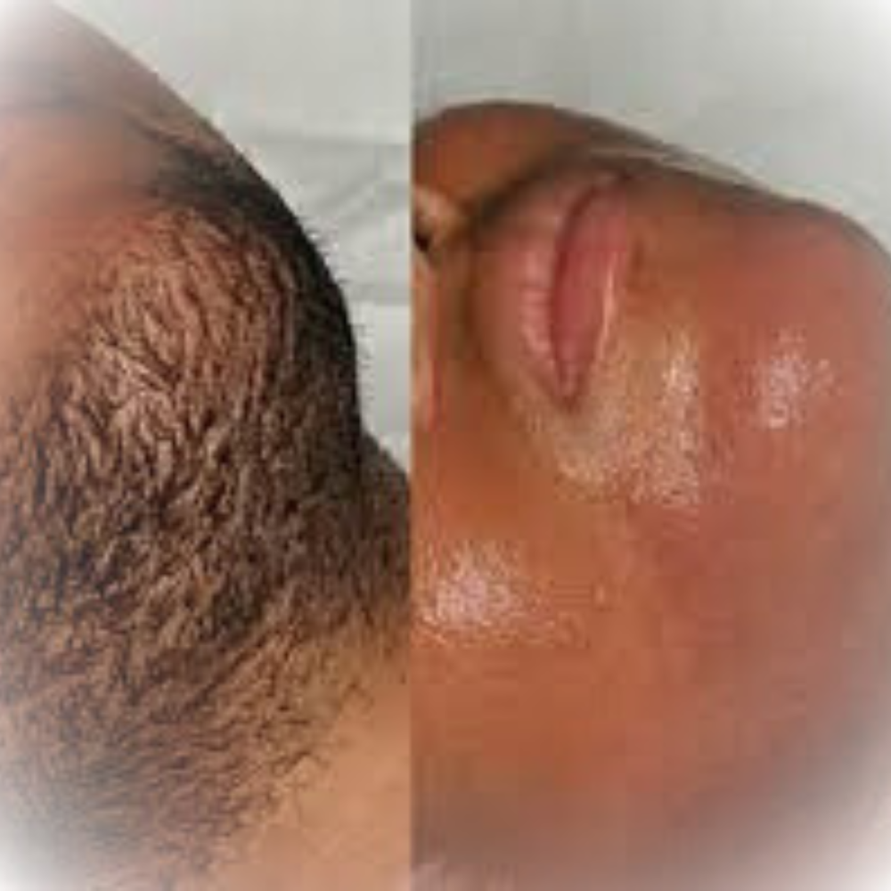 PCOS/Hirsutism Facial