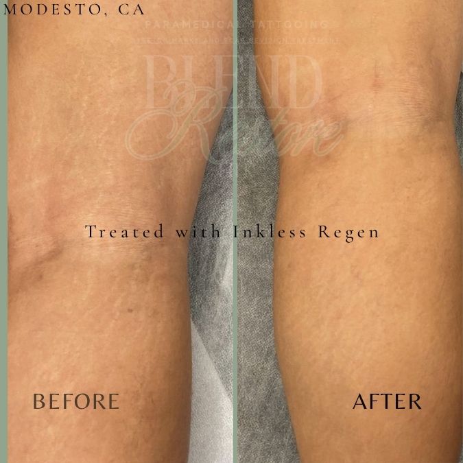 3 Area Package Stretch Marks/Scars
