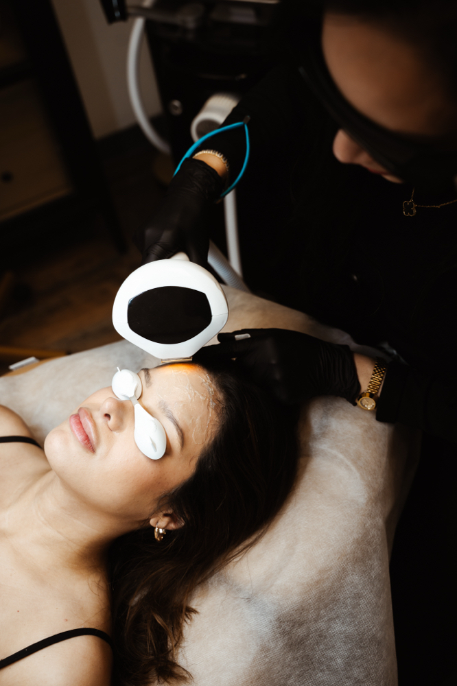 IPL Photofacial Treatment